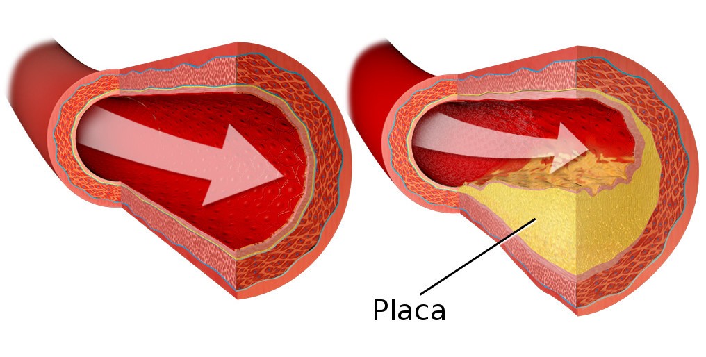 Aterosclerose-2