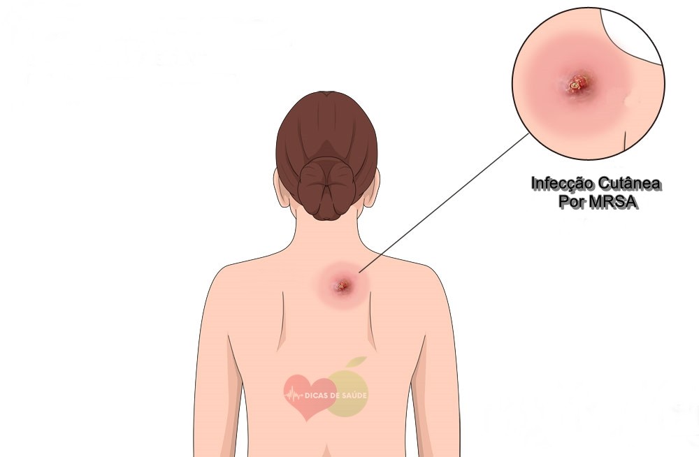 Como Identificar os Sintomas da Infecção por MRSA