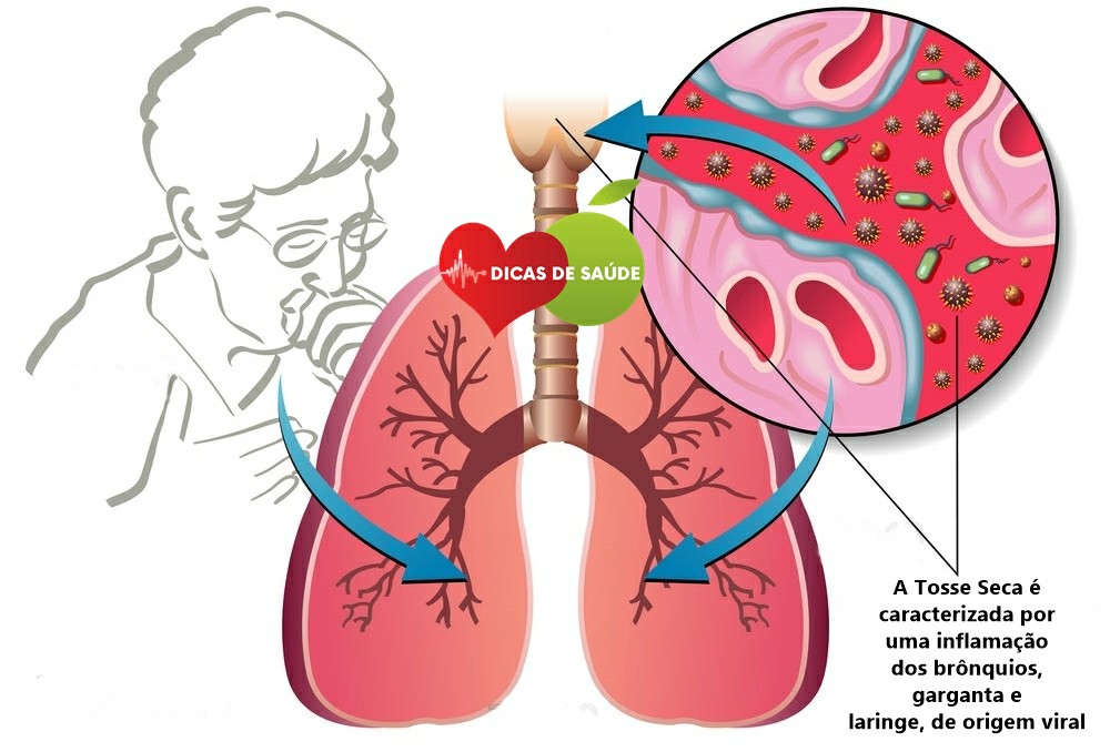 Como Tratar a Tosse Seca
