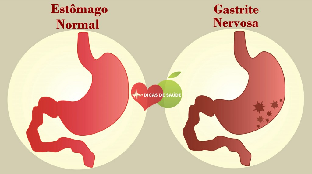 Curar a Gastrite Nervosa