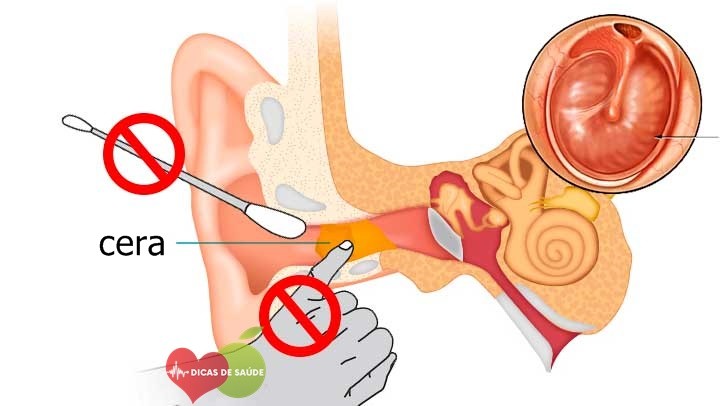 Dicas de Como Remover Cera do Ouvido 1