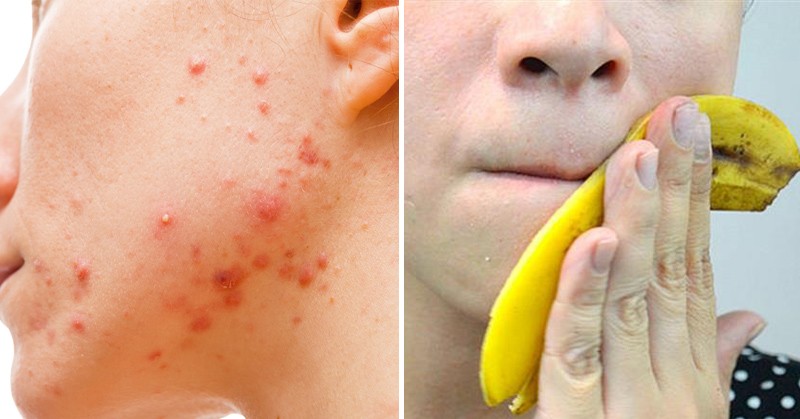 Elimine a Acne em Apenas 4 Dias Usando Casca de Banana