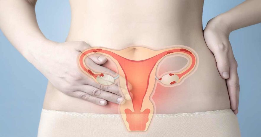 Sintomas da Endometriose