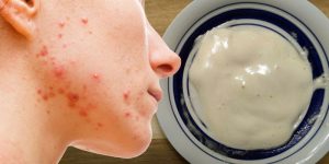 Máscara Caseira Para Eliminar Manchas e Acne em 7 Dias