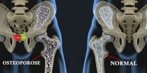 Remédios Mais Usados Para Tratar Osteoporose