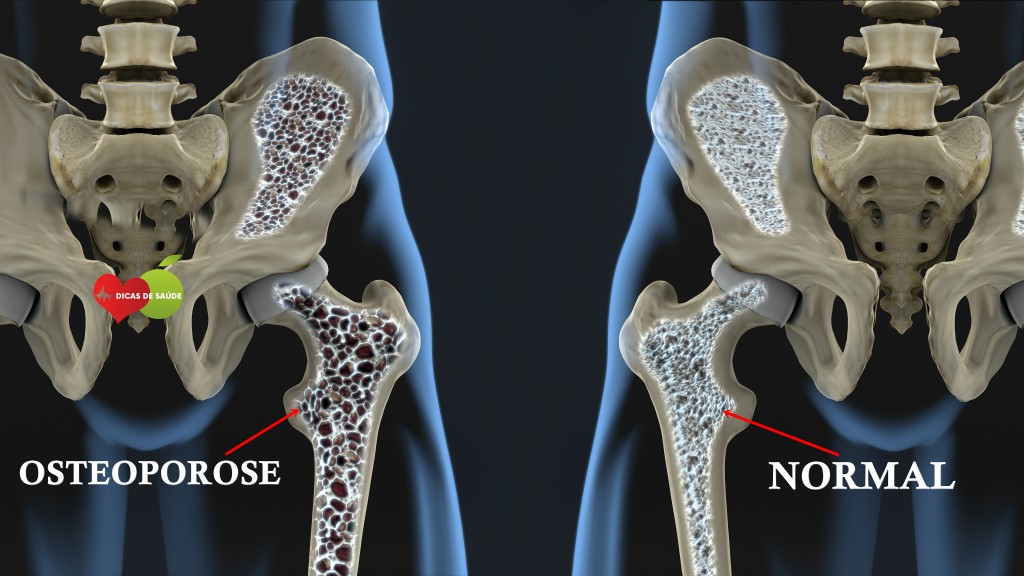 Remédios Mais Usados Para Tratar Osteoporose