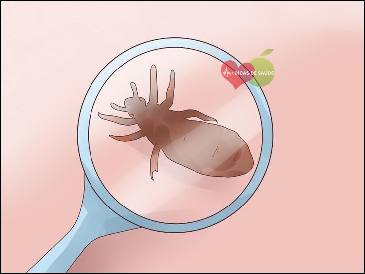 Piolho Pubiano Causas Sintomas e Tratamentos