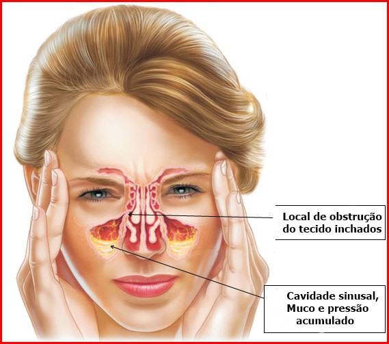 Tratar Sinusite