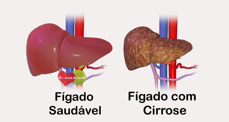 Principais Sintomas da Cirrose