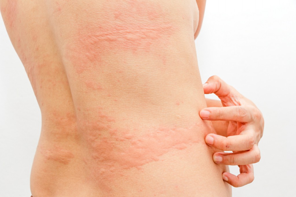 Urticaria 1