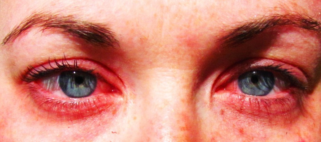 Alergia Ocular