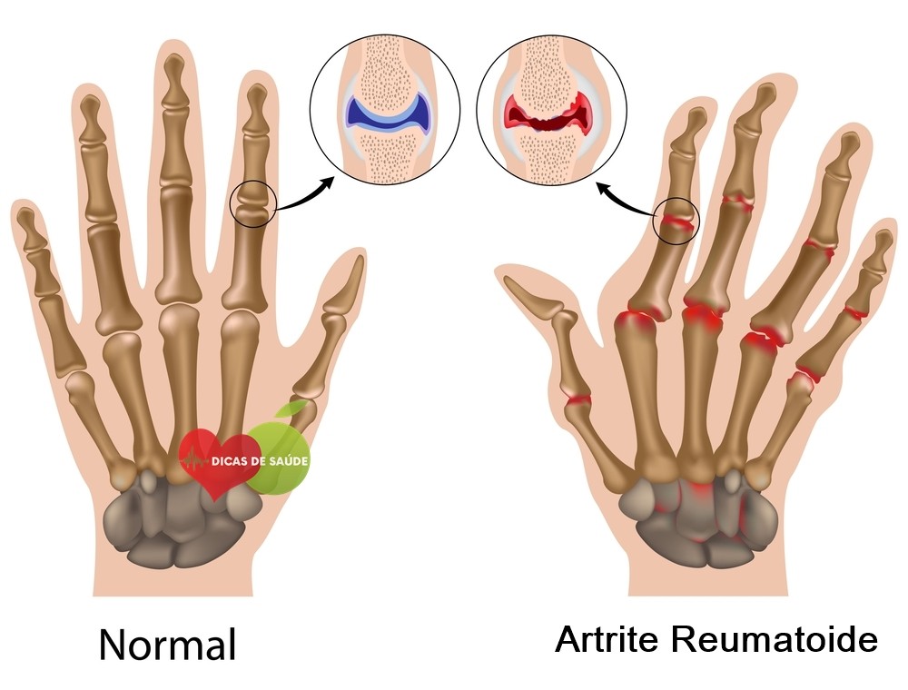 Como Tratar a Artrite Reumatoide