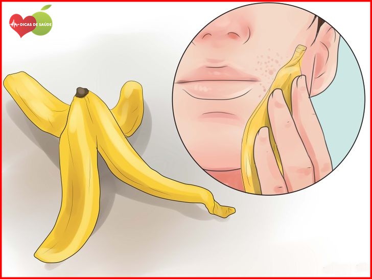 Elimine a Acne em Apenas 4 Dias Usando Casca de Banana