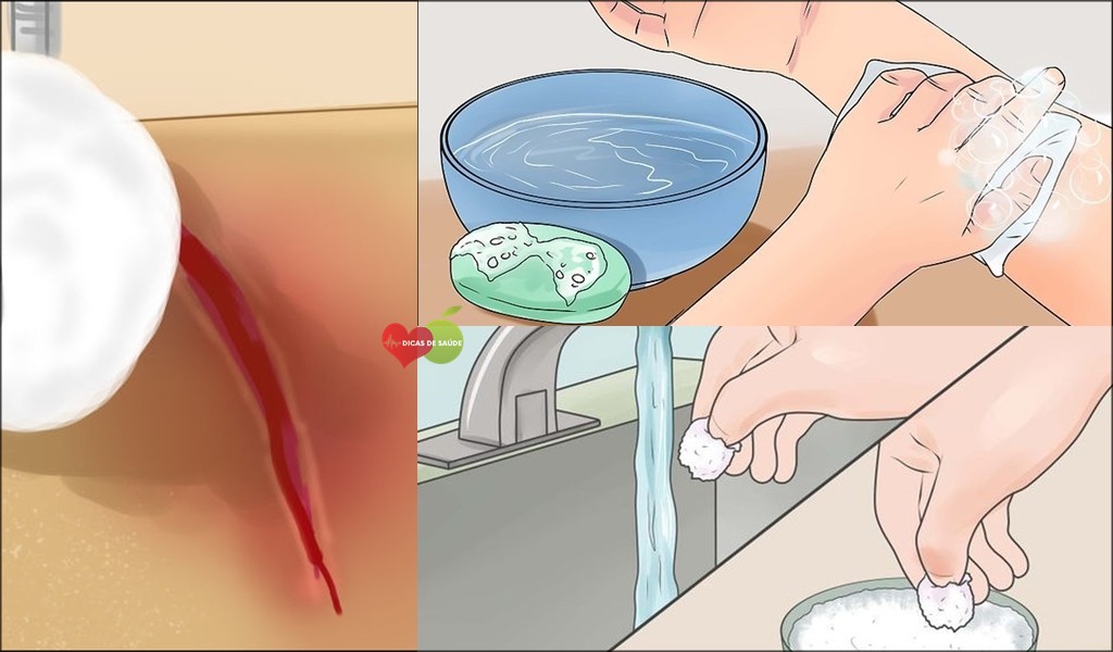 Remédios Caseiros Para Cicatrização de Feridas