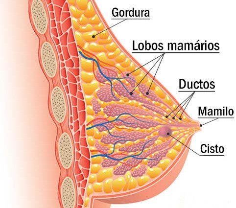 Cisto Na Mama - O que é