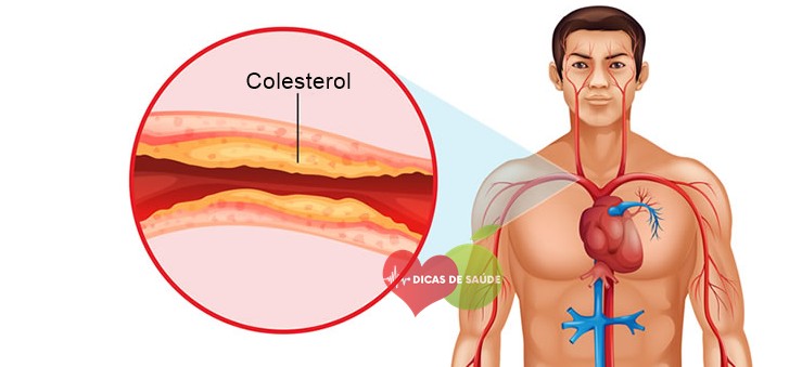 Como Reduzir o Colesterol