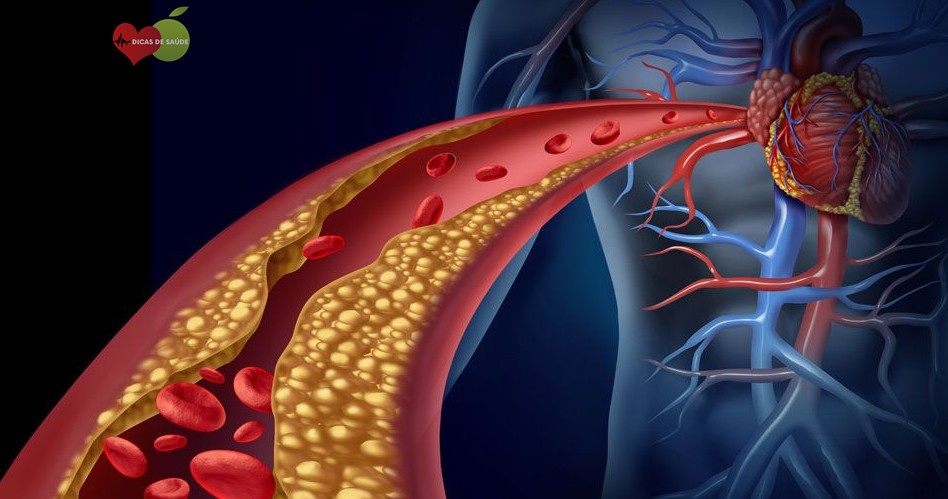 Receita Natural Para Baixar o Colesterol Rapidamente