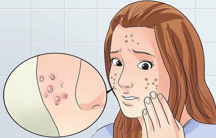 como Eliminar a acne