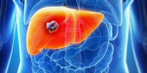 Principais Sintomas de Câncer no Fígado