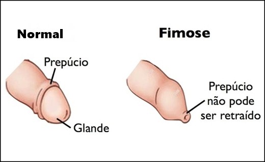 fimose tratar