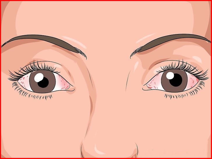 Receitas Caseira Para Irritação Nos Olhos