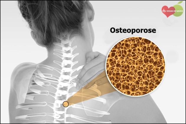 osteoporose