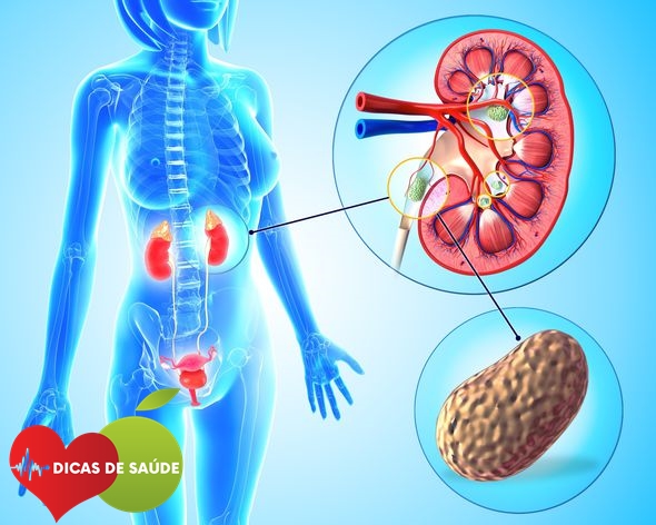 Sintomas de Pedras nos Rins
