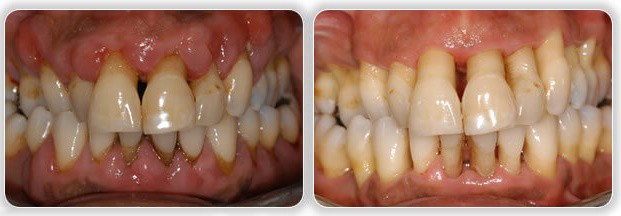 periodontitie causas 1