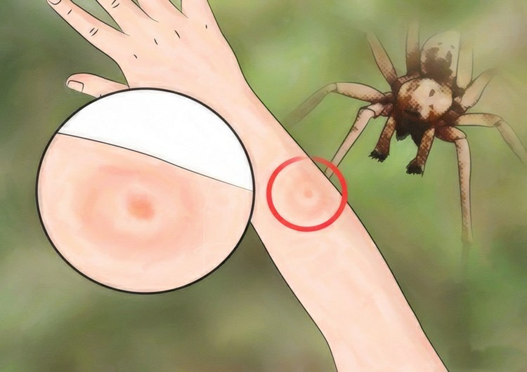 Como Tratar Picadas de Aranha