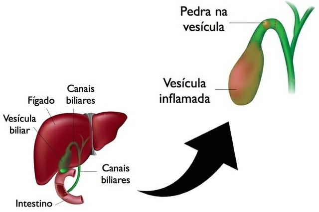 Sintomas de Pedra na Vesícula