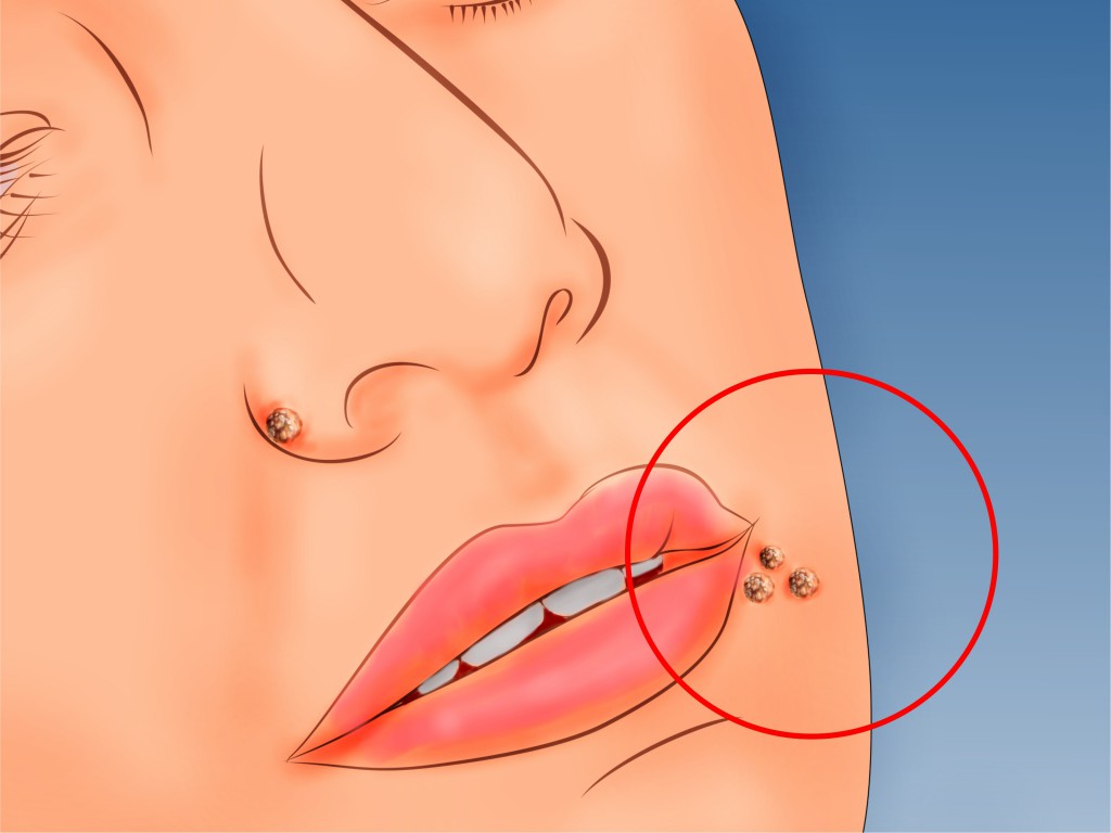 Receitas Caseira Para Eliminar de Vez Verrugas no Rosto