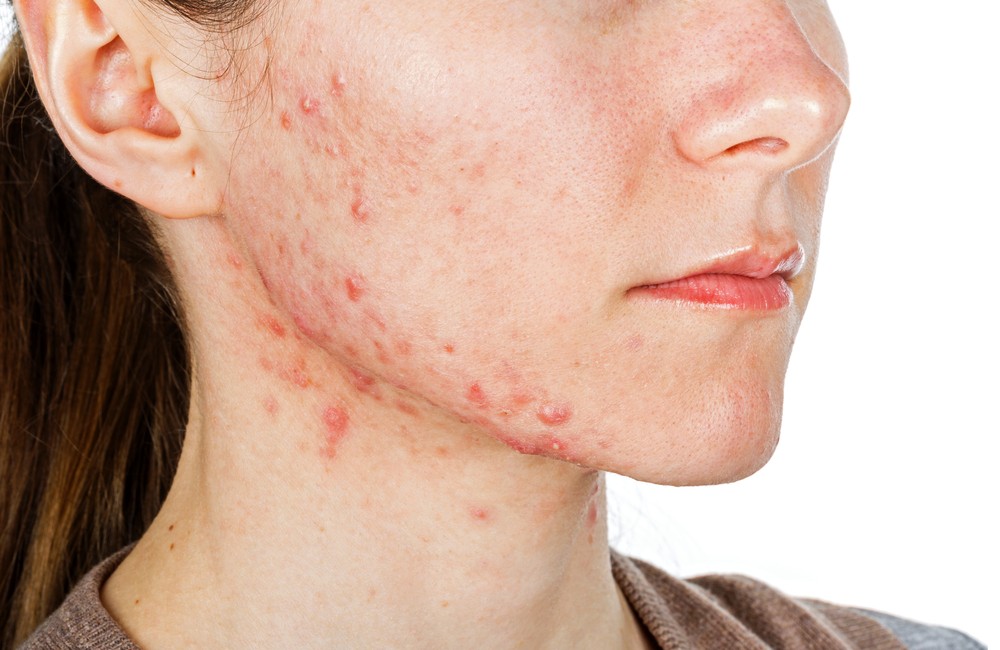 Acne Causas Sintomas e Tratamentos