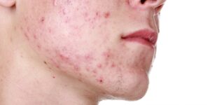 Tratar Acne Cística