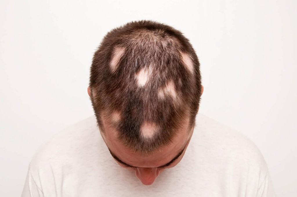 Alopecia Areata 1