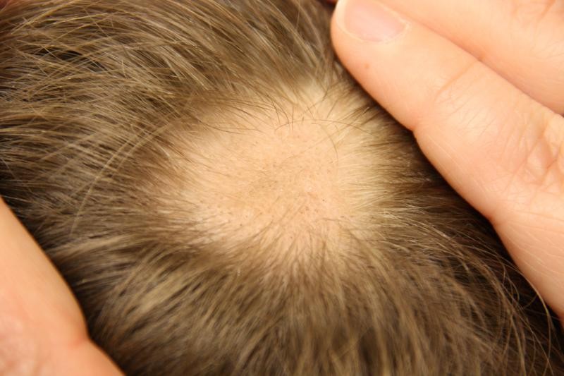 Causas da Alopecia Areata