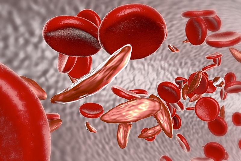 Anemia Falciforme