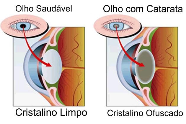 Causas da Catarata