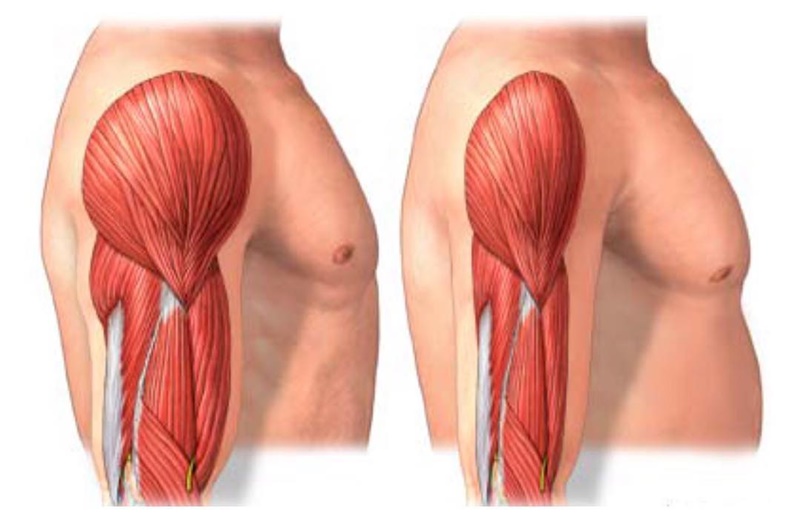 Atrofia muscular 2