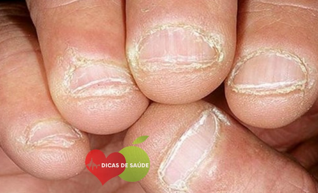 Sintomas da Deficiência de Vitamina B2 Sintomas da Deficiência de Vitamina B2