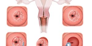 Displasia Cervical