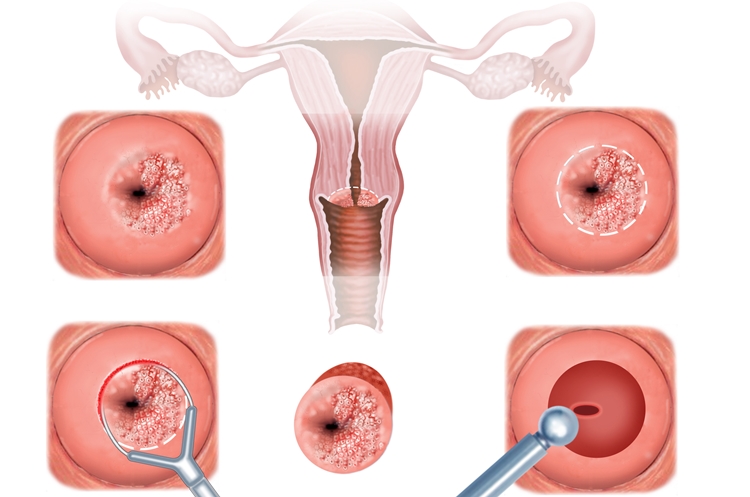 Displasia Cervical