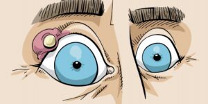 Doenças Comuns que Podem Atingir os Olhos