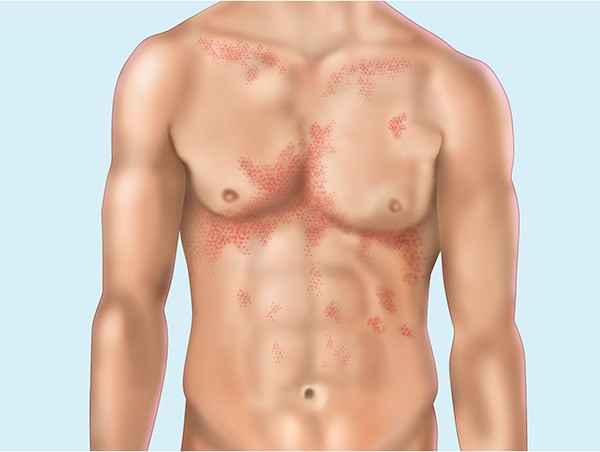 Sintomas de Eczema Numular