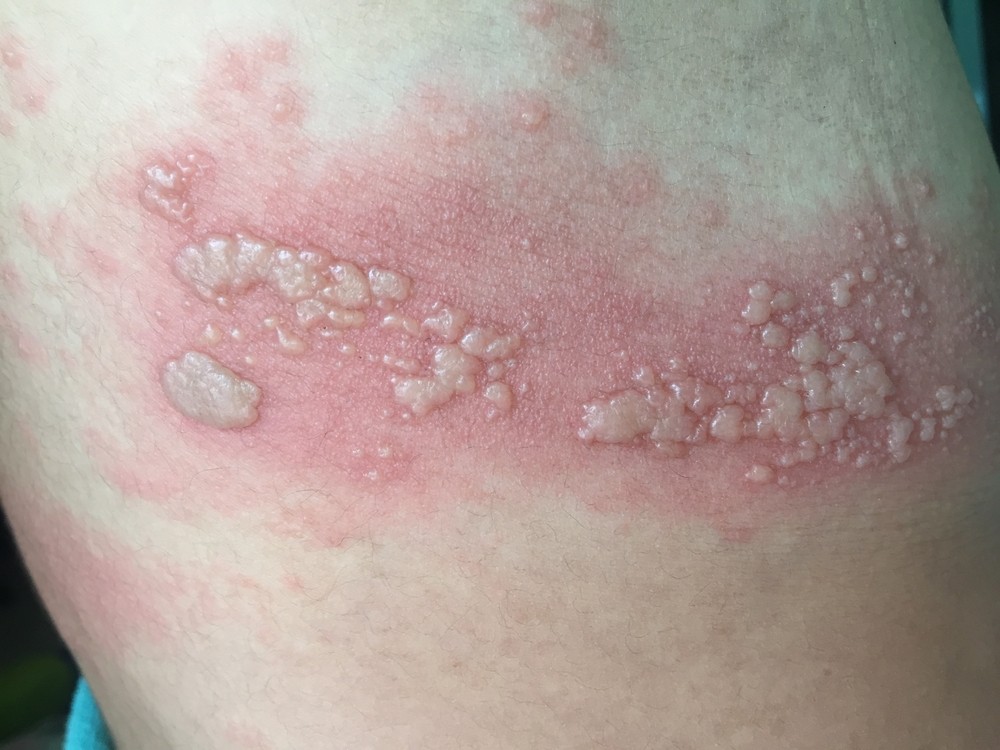 Eczema Numular