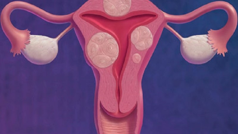 Fibroides Uterinos