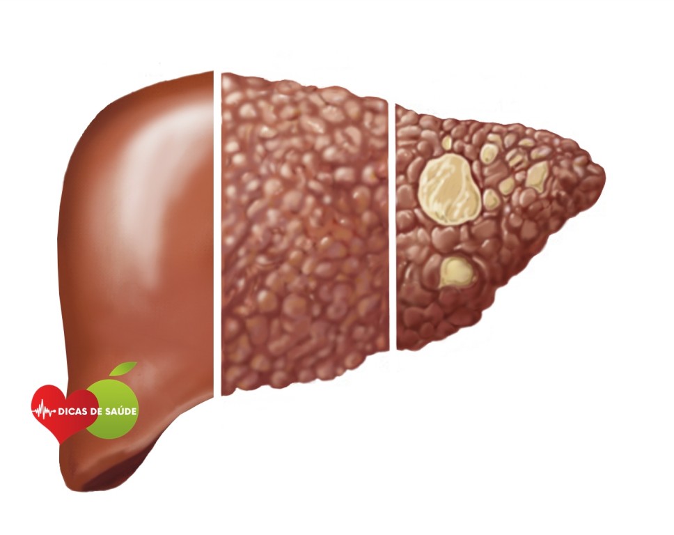 Hemocromatose 1 1