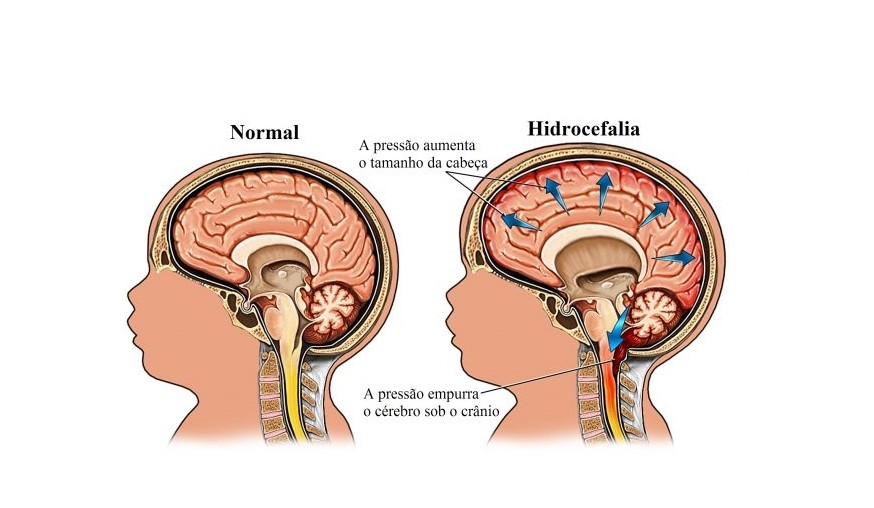Hidrocefalia 2 1