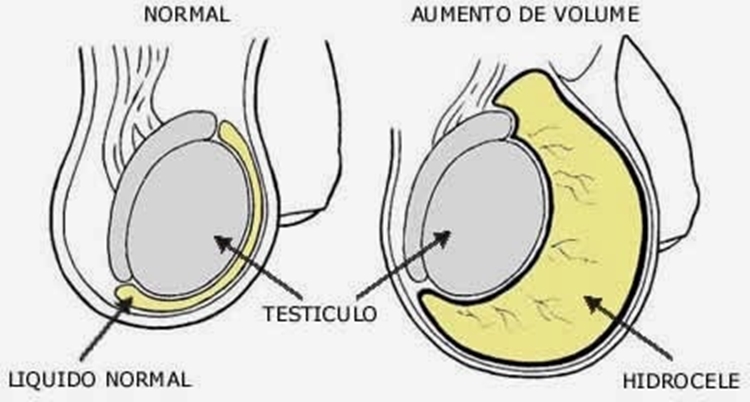 Hidrocele 2