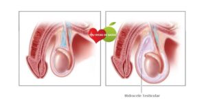 Hidrocele Testicular-1