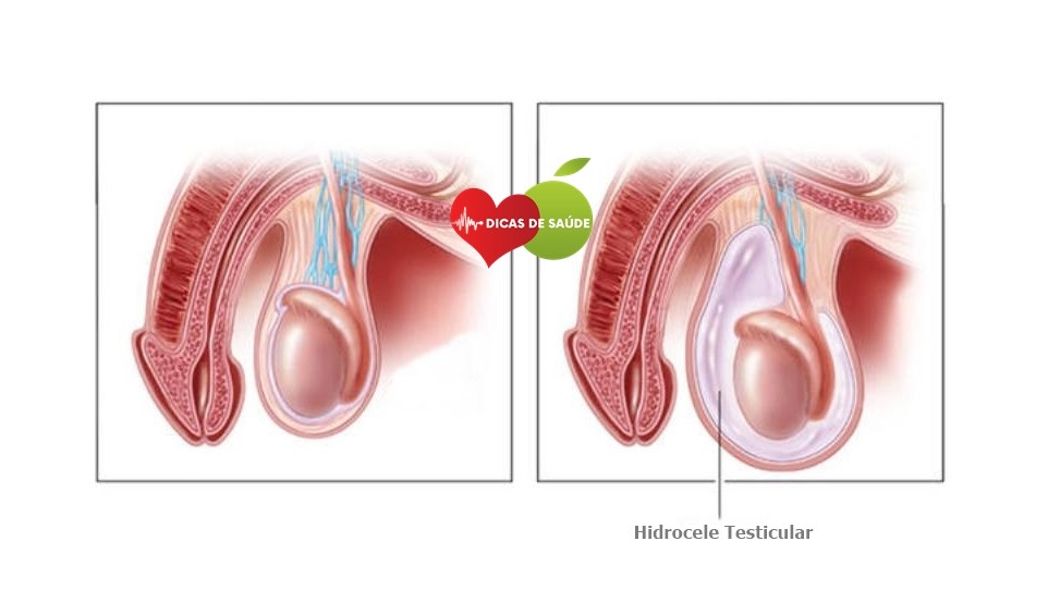 Hidrocele Testicular-1